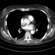 Thrombosis of superior vena cava: CT - Computed tomography